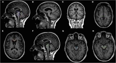 Frontiers | Association Of MRI Measures With Disease Severity And ...